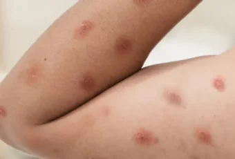 Ceará confirma cinco casos de Mpox em 2026